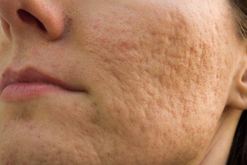 Welcome Any Indigenous Laserowe usuwanie blizn potrądzikowych | Laseroterapia na blizny | dr Łukasz Bełza Welcome Any Indigenous Laserowe usuwanie blizn potrądzikowych | Laseroterapia na blizny | dr Łukasz Bełza